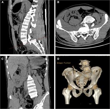 Case report: Traumatic lumbosacral spondyloptosis with locked L5 inferior articular process